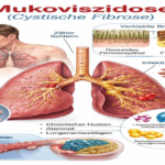 Mukoviszidose