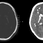 Fahr Syndrome