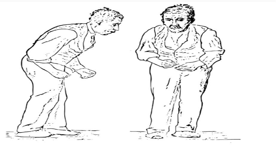 Illustration der Parkinson-Krankheit von William Richard Gowers